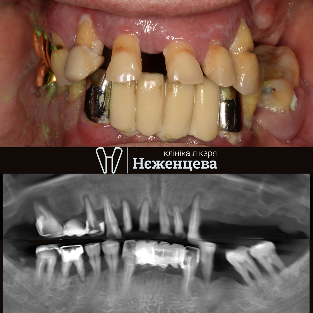 До лікування