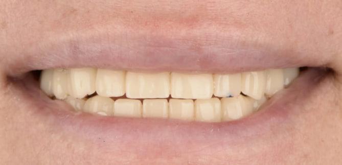 Після лікування