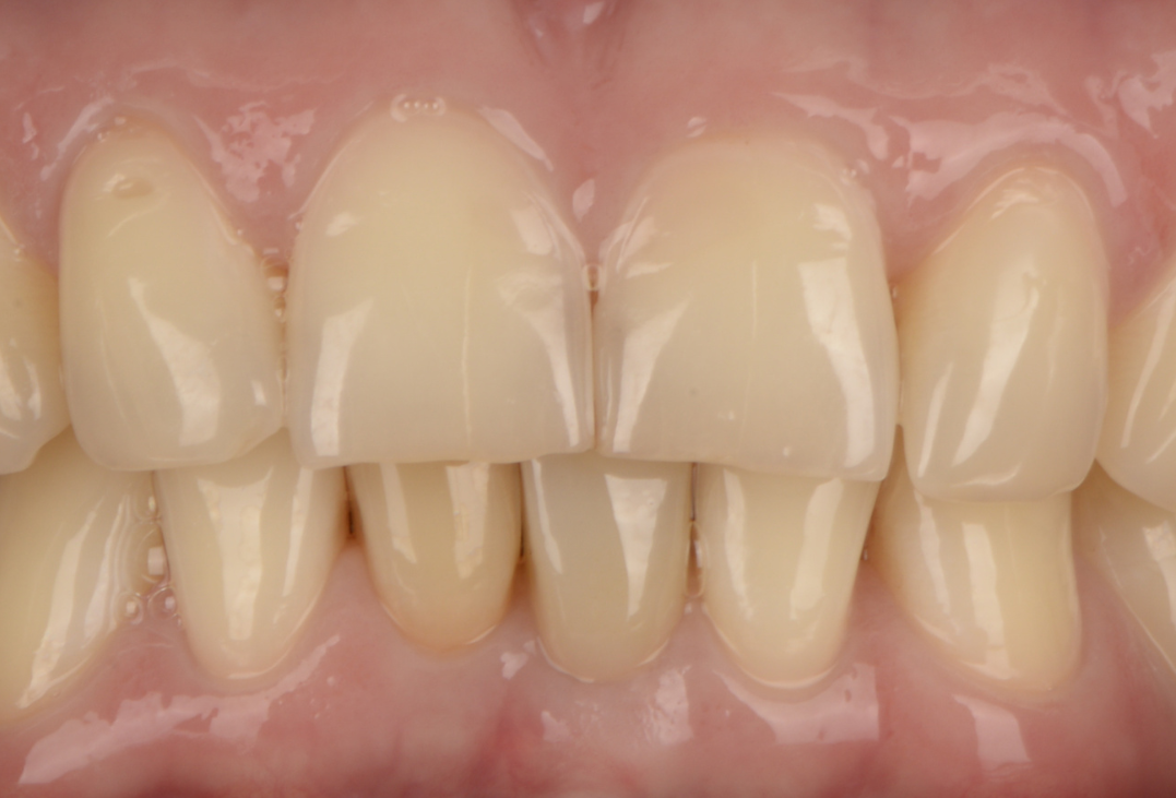 Після лікування