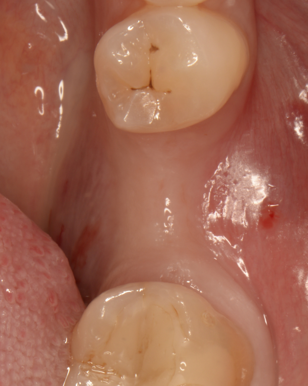 До лікування