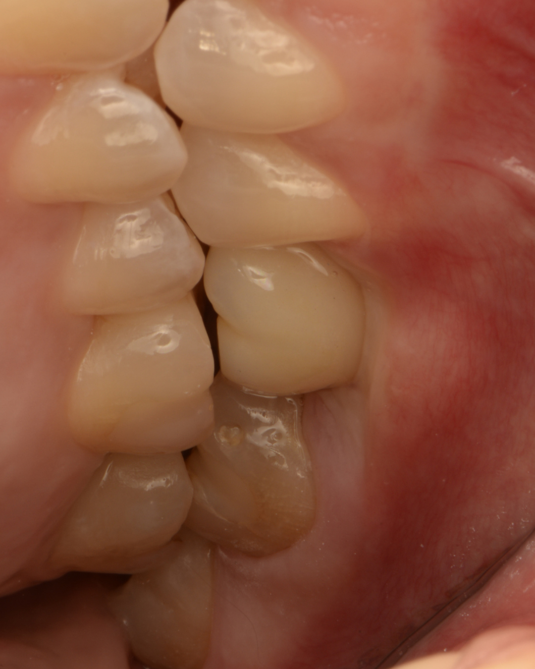 Після лікування