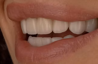 Лікування карієсу