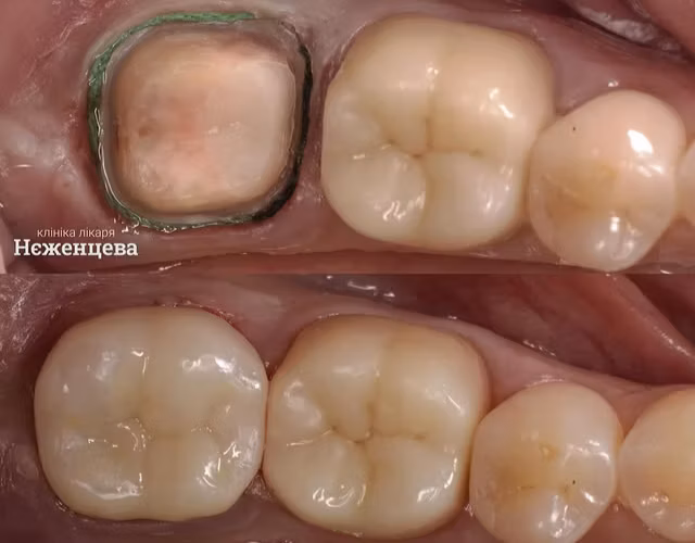 Ортопедичне відновлення зуба